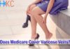 Does Medicare Cover Varicose Veins?