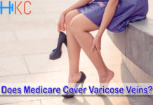 Does Medicare Cover Varicose Veins?