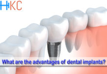 What are the advantages of dental implants?