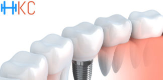 What are the advantages of dental implants?