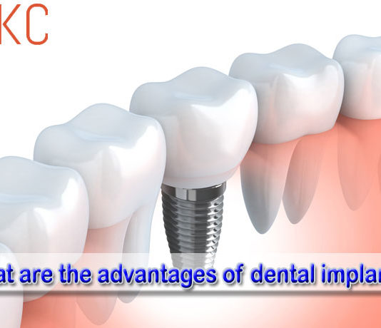 What are the advantages of dental implants?