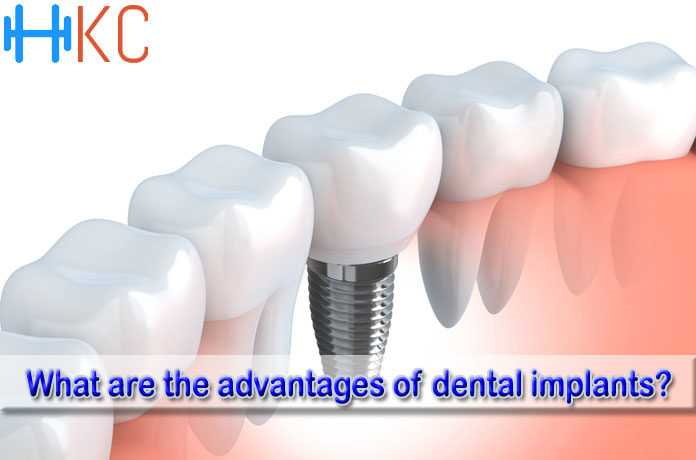 What are the advantages of dental implants?