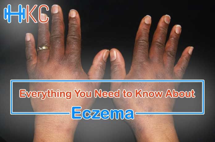 Know about Eczema