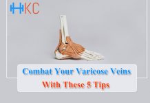 Varicose Veins