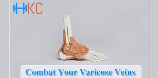 Varicose Veins