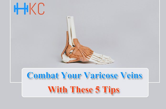 Varicose Veins