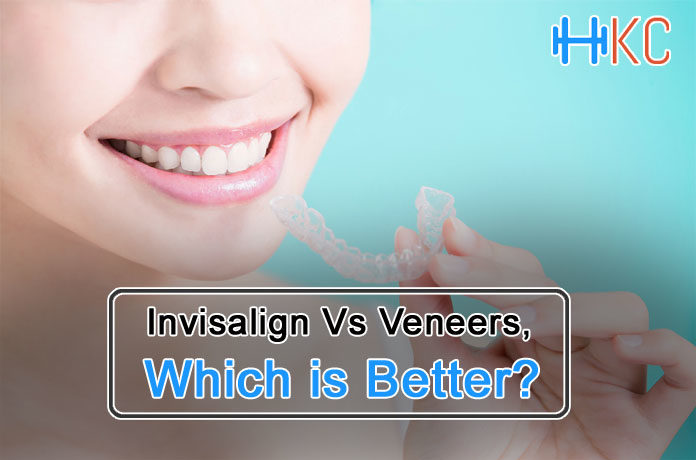 Invisalign Vs Veneers