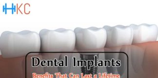 Dental Implants