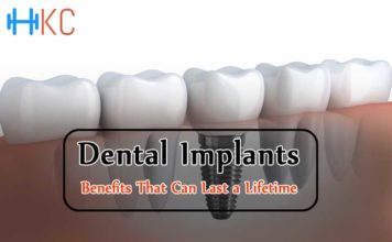 Dental Implants