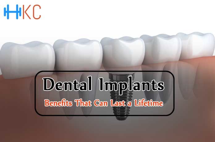 Dental Implants